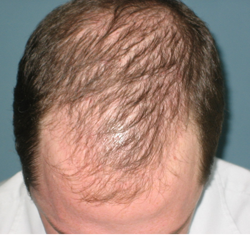 regrow temple hair loss